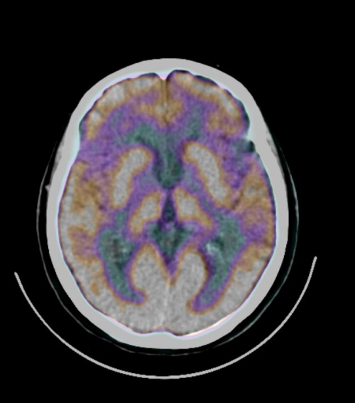 Medicina Nucleare: è iniziata l'attività in Fondazione Poliambulanza