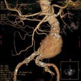 Aneurisma aorta addominale: convegno 11 maggio