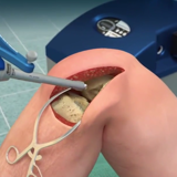 Protesi al ginocchio: in Poliambulanza arriva la chirurgia robotica “Navio”