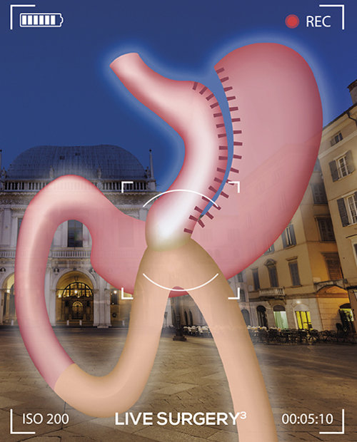 15 Aprile 2019 European Bariatric Live  – Interventi di chirurgia bariatrica in diretta streaming 