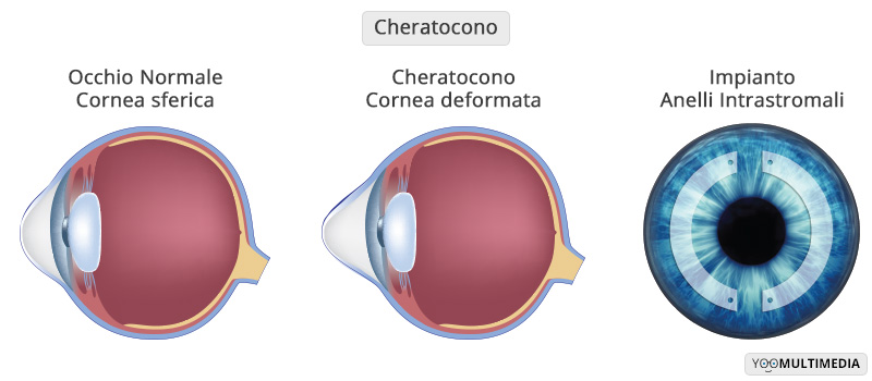 Cheratocono Anelli Intrastromali Poliambulanza