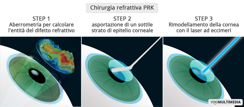 Chirurgia Refrattiva PRK Poliambulanza