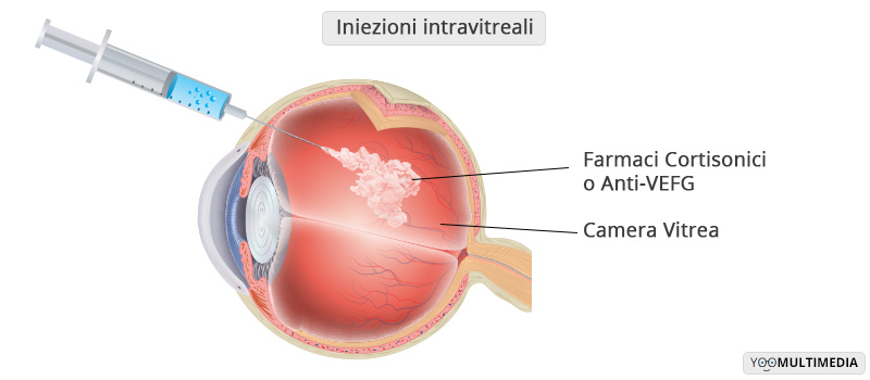 Iniezioni Intra Vitreali Poliambulanza