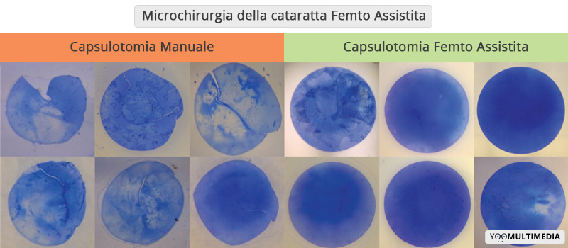 Intervento Cataratta Flacs Capsulotomia Poliambulanza