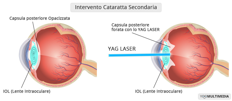 Intervento Cataratta Secondaria Poliambulanza