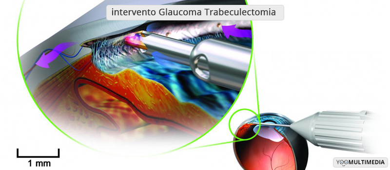 Intervento Glaucoma Trabeculectomia Poliambulanza