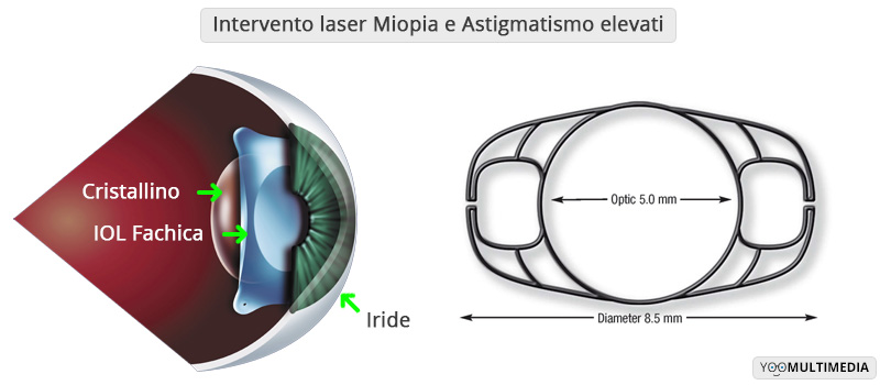 Intervento laser Miopia e Astigmatismo Elevati IOL Fachiche Poliambulanza