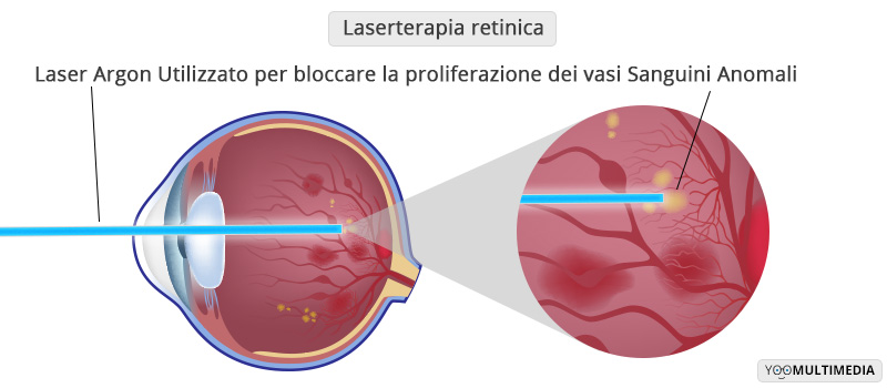 Laser Terapia Retinica Poliambulanza