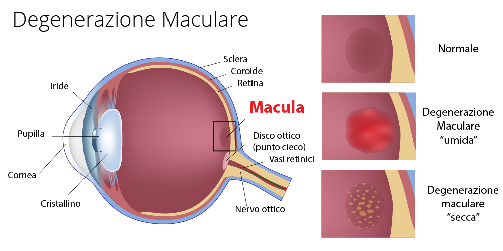 Maculopatia Poliambulanza