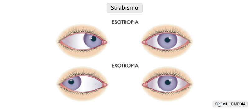 Strabismo chirurgia Poliambulanza