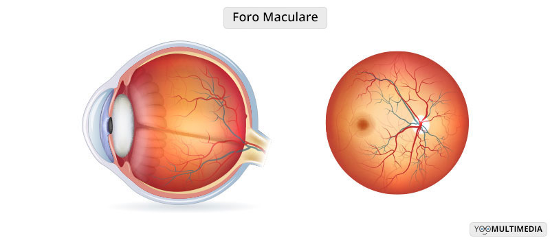 foro maculare Poliambulanza