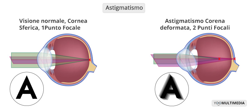 Astigmatismo Poliambulanza