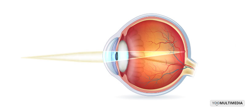 Biometria oculare Poliambulanza