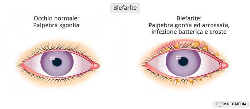 Blefarite Poliambulanza