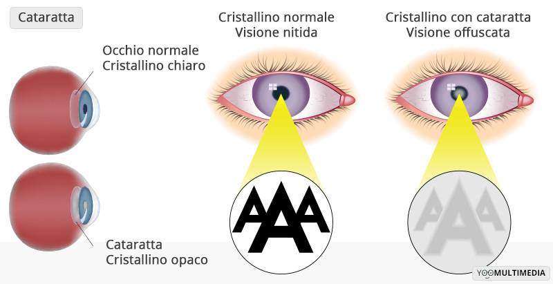Cataratta Poliambulanza