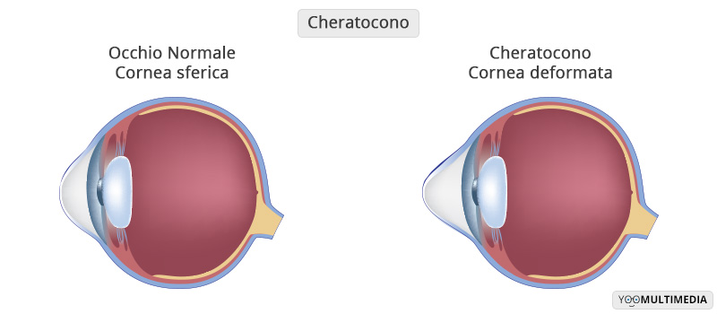 Cheratocono Poliambulanza