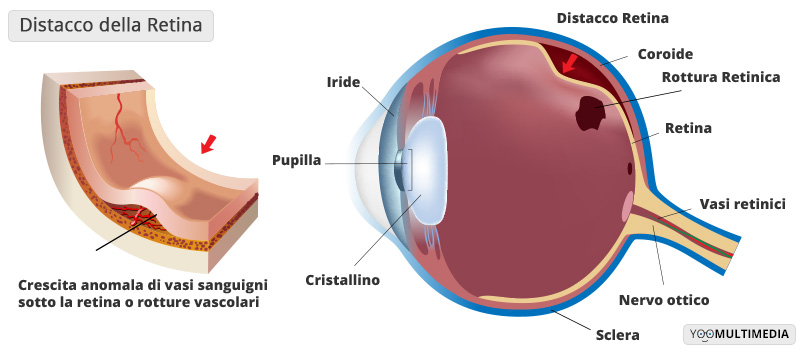 Distacco Della Retina Poliambulanza