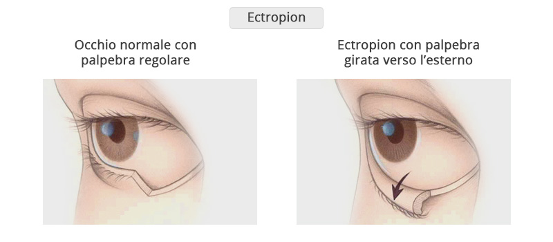 Ectropion Poliambulanza