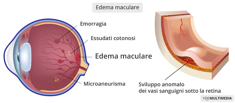 Edema Maculare Poliambulanza