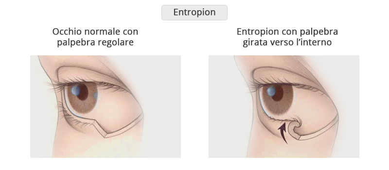 Entropion Poliambulanza