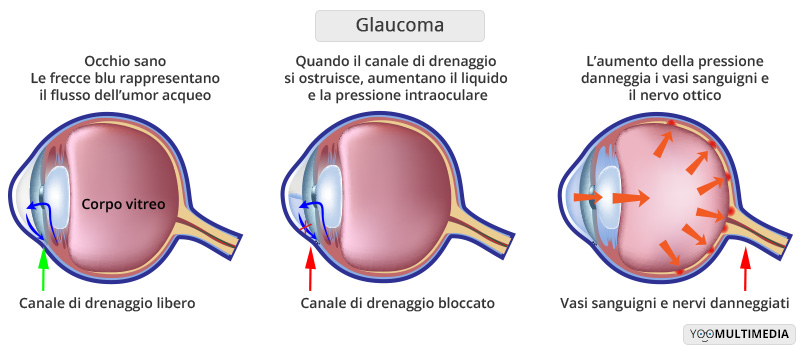 Glaucoma Poliambulanza