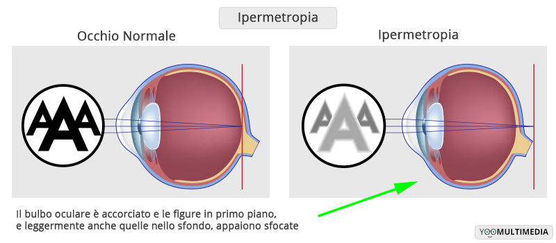 Ipermetropia Poliambulanza