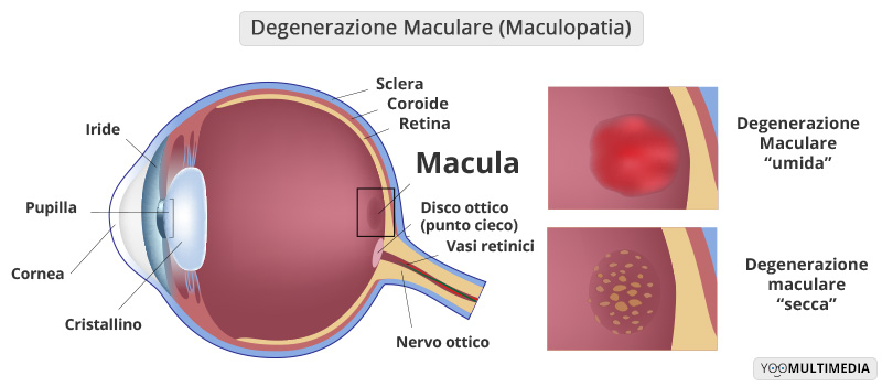 Maculopatia Poliambulanza