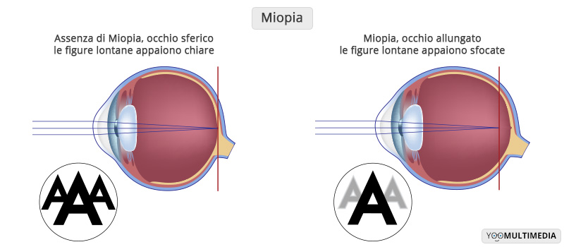 Miopia Poliambulanza