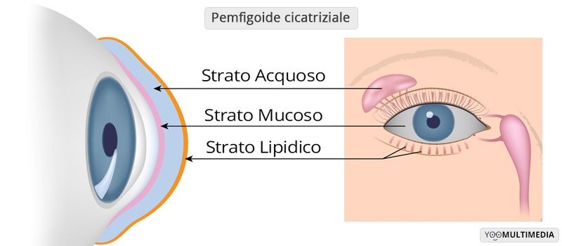 Pemfigoide Cicatriziale Poliambulanza