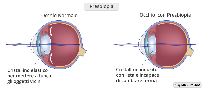 presbiopia cause