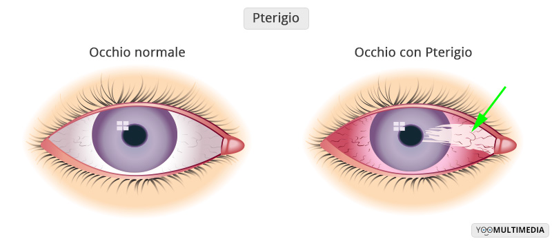 Pterigio Poliambulanza