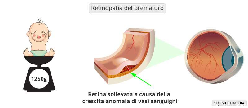 Retinopatia del prematuro Poliambulanza