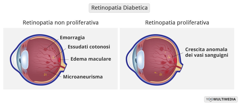 Retinopatia diabetica Poliambulanza