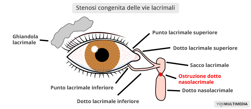 Stenosi congenita delle vie lacrimali Poliambulanza