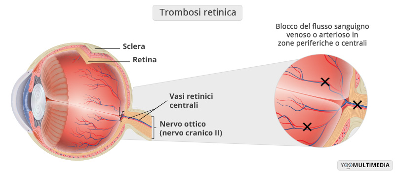 Trombosi retinica Poliambulanza