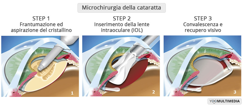Micro Chirurgia Della Cataratta poliambulanza