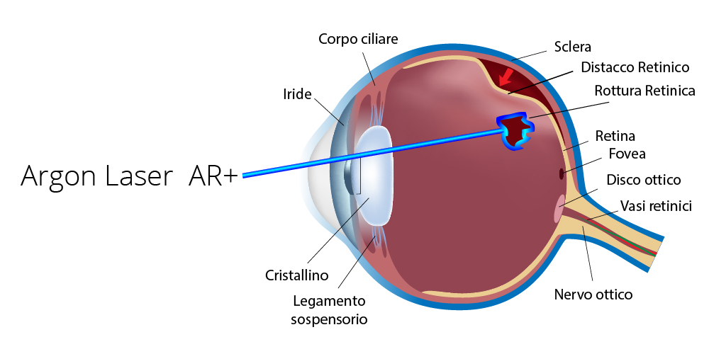 Argon Laser Terapia Retinica Poliambulanza