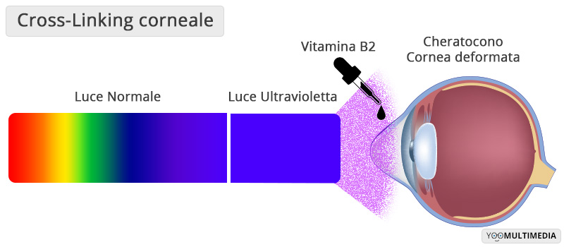 Cross Linking Corneale Poliambulanza