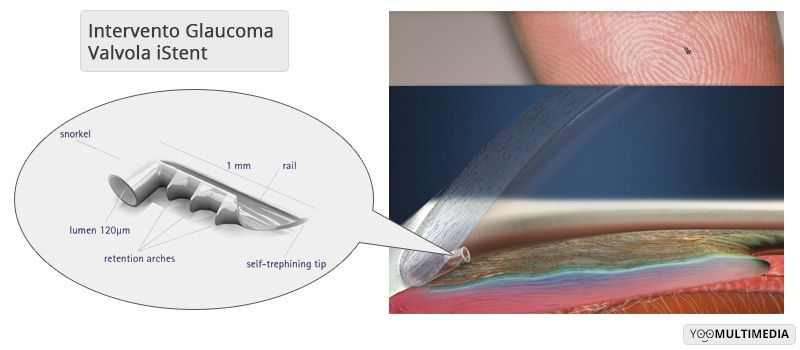 Intervento Glaucoma Valvola poliambulanza