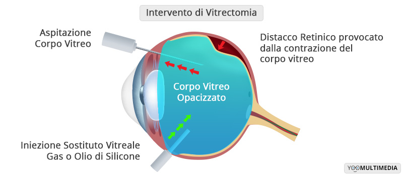 Intervento Vitrectomia Poliambulanza