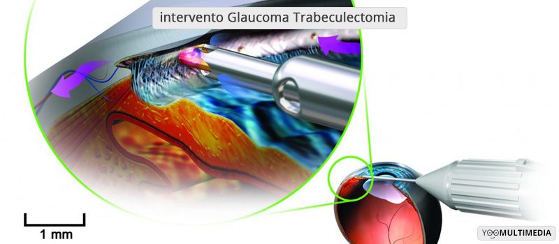 intervento Glaucoma Trabeculectomia poliambulanza